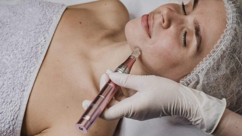 Microneedling con dermapen en Bilbao